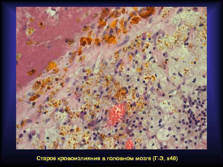 Старое кровоизлияние в головном мозге (Г-Э, х40) 