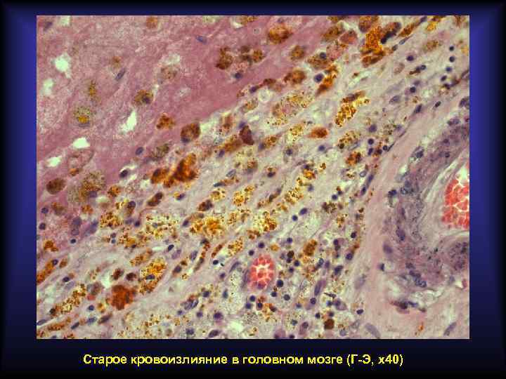 Старое кровоизлияние в головном мозге (Г-Э, х40) 