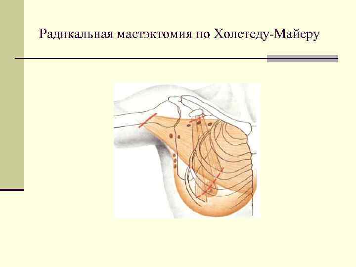 Мастэктомия по холстеду