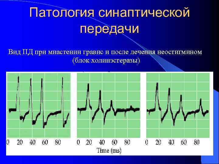 Патология синаптической передачи Вид ПД при миастении гравис и после лечения неостигмином (блок холинэстеразы)