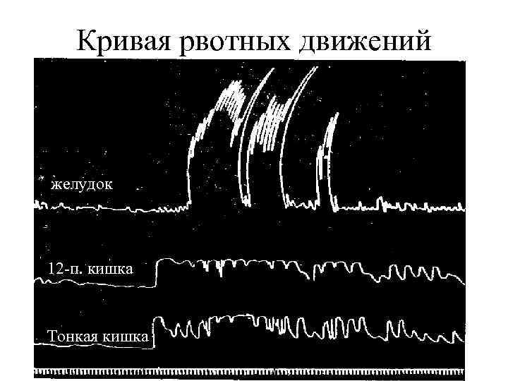 Кривая рвотных движений желудок 12 -п. кишка Тонкая кишка 