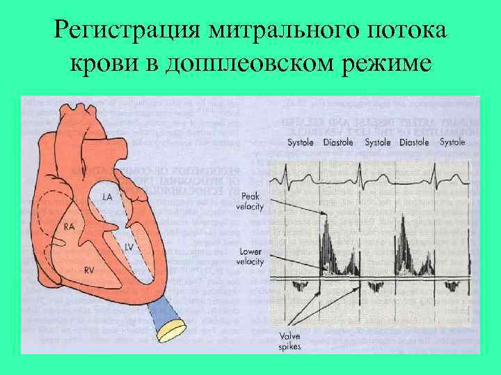 Регистрация митрального потока крови в допплеовском режиме 
