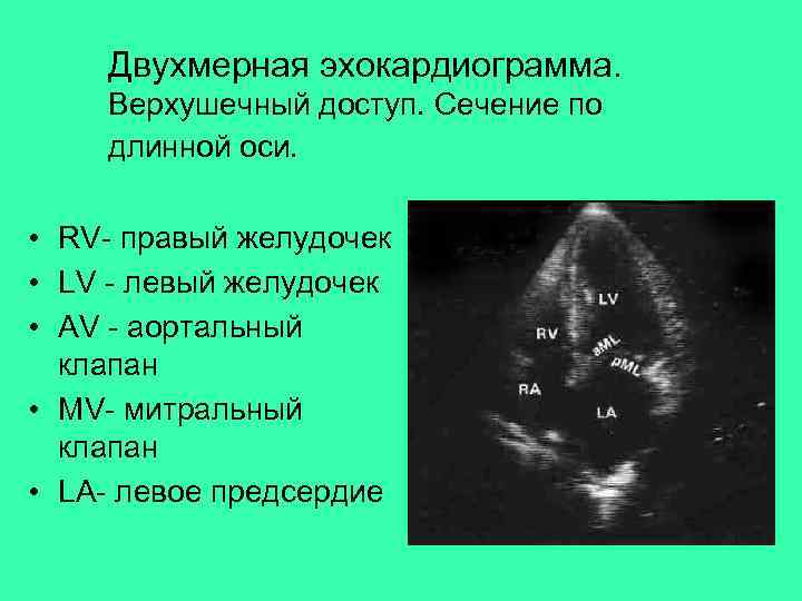 Двухмерная эхокардиограмма. Верхушечный доступ. Сечение по длинной оси. • RV- правый желудочек • LV