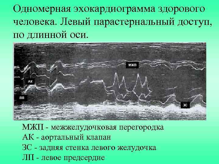 Одномерная эхокардиограмма здорового человека. Левый парастернальный доступ, по длинной оси. МЖП АК ЛП ЗС