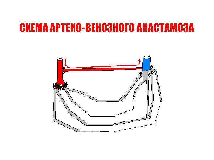 СХЕМА АРТЕИО-ВЕНОЗНОГО АНАСТАМОЗА 