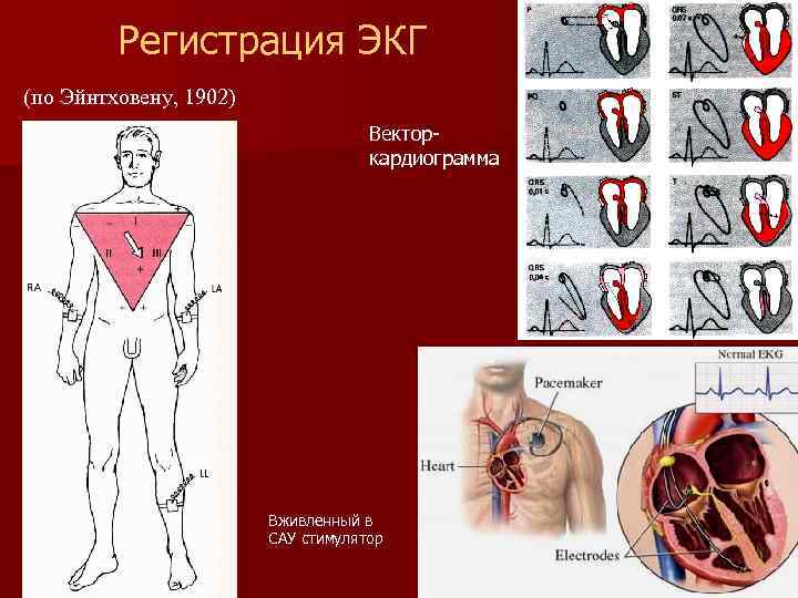 Регистрация ЭКГ (по Эйнтховену, 1902) Векторкардиограмма Вживленный в САУ стимулятор 