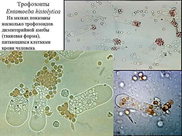 Трофозоиты Entamoeba histolytica На мазках показаны несколько трофозоидов дизентерийной амебы (тканевая форма), питающихся клетками