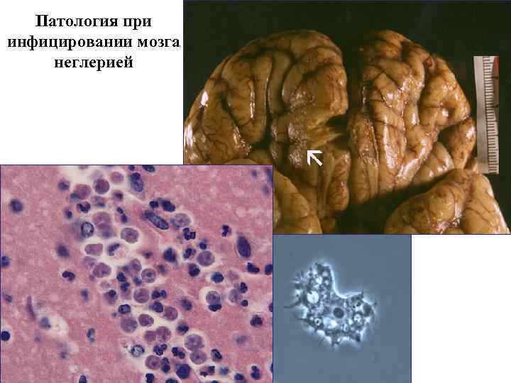 Патология при инфицировании мозга неглерией 