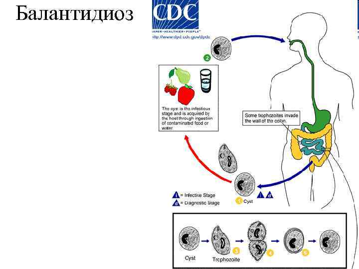 Балантидиоз 