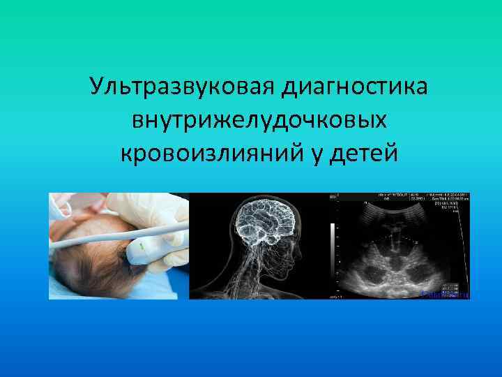 Ультразвуковая диагностика внутрижелудочковых кровоизлияний у детей 