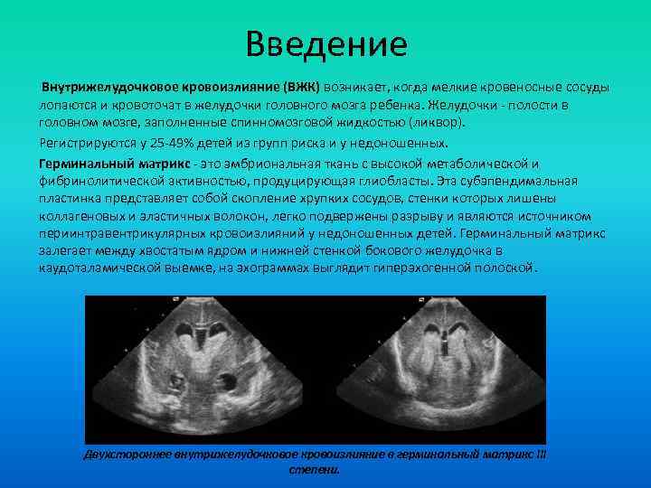 Введение Внутрижелудочковое кровоизлияние (ВЖК) возникает, когда мелкие кровеносные сосуды лопаются и кровоточат в желудочки