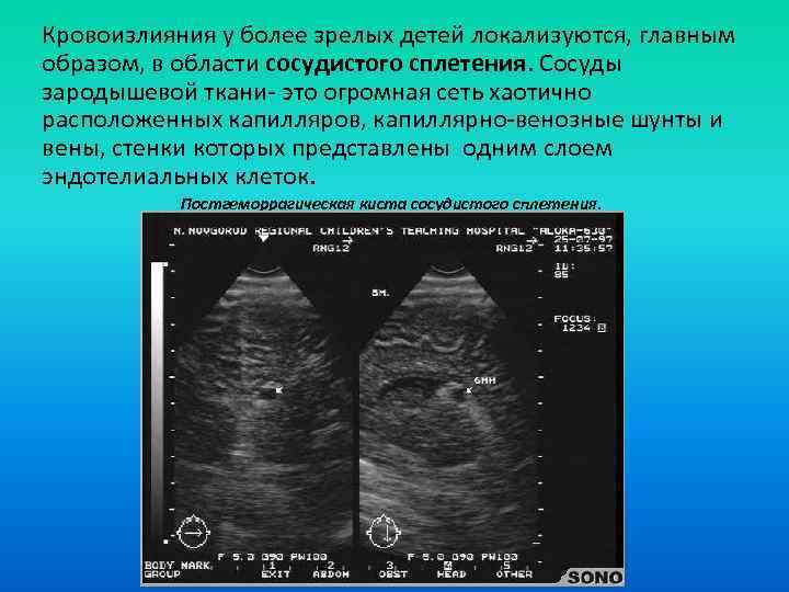 Кровоизлияния у более зрелых детей локализуются, главным образом, в области сосудистого сплетения. Сосуды зародышевой