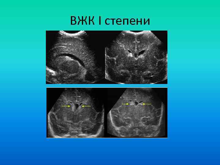 ВЖК I степени 