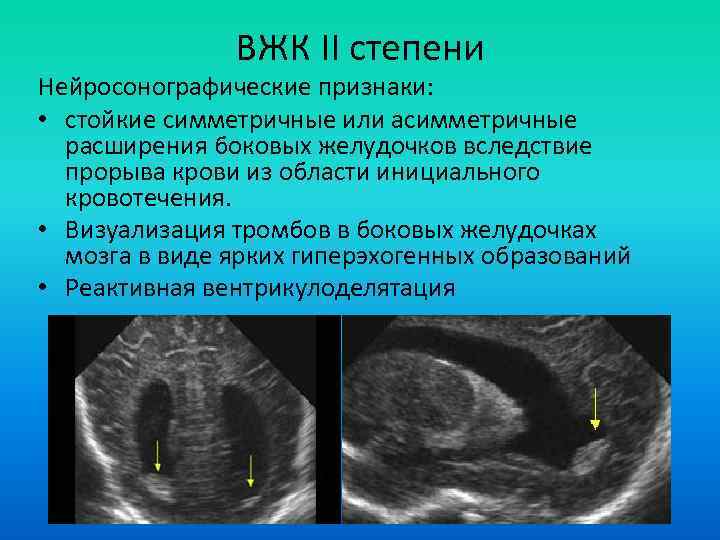 ВЖК II степени Нейросонографические признаки: • стойкие симметричные или асимметричные расширения боковых желудочков вследствие