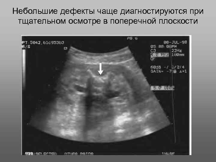 Небольшие дефекты чаще диагностируются при тщательном осмотре в поперечной плоскости 