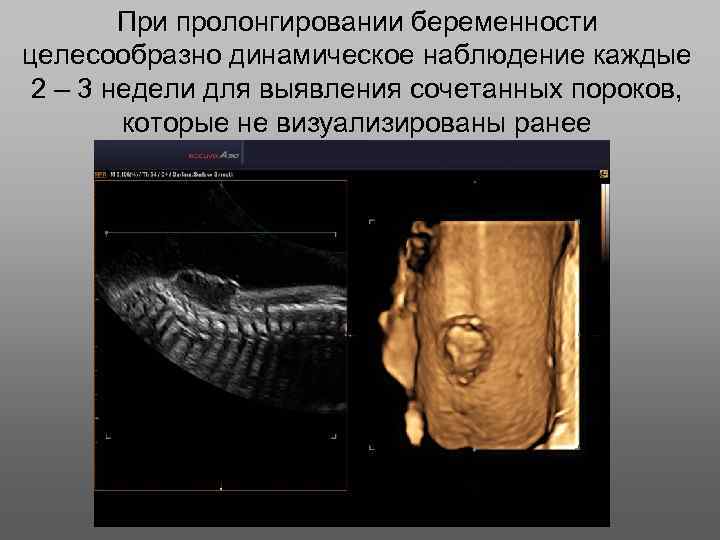 При пролонгировании беременности целесообразно динамическое наблюдение каждые 2 – 3 недели для выявления сочетанных