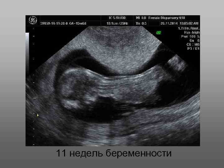 11 недель беременности 