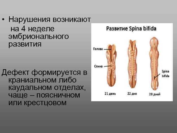  • Нарушения возникают на 4 неделе эмбрионального развития Дефект формируется в краниальном либо