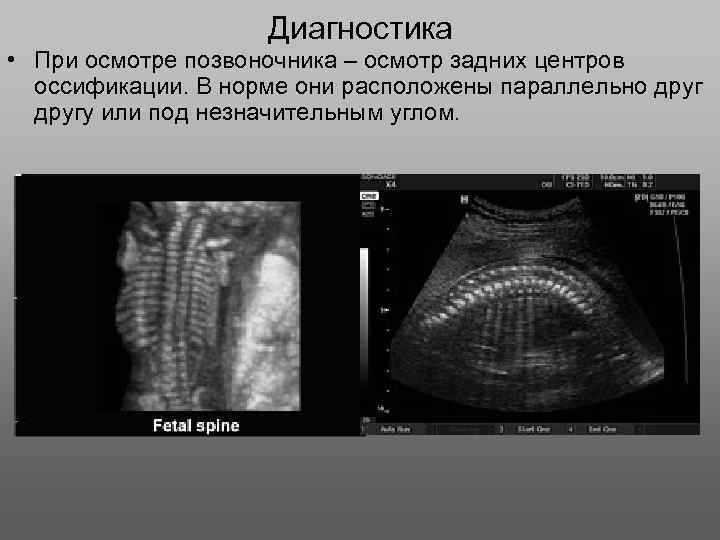 Диагностика • При осмотре позвоночника – осмотр задних центров оссификации. В норме они расположены