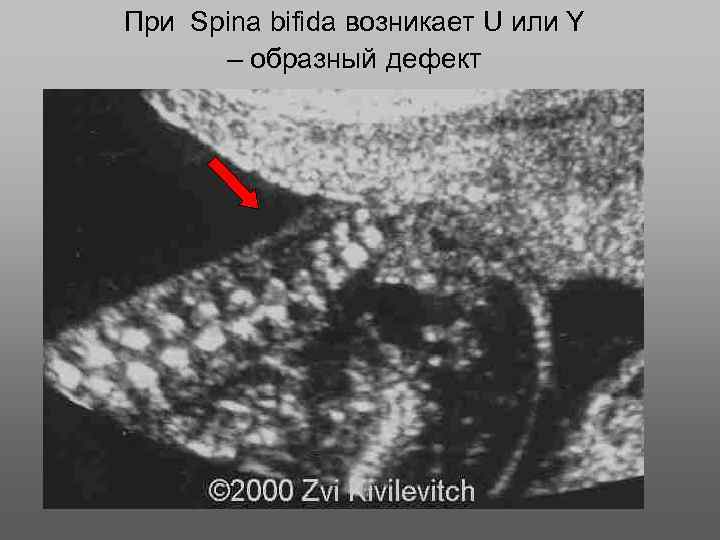 При Spina bifida возникает U или Y – образный дефект 