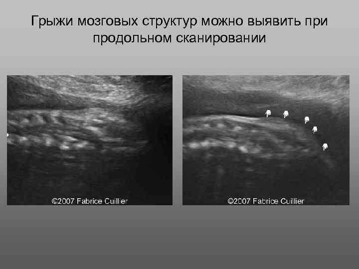 Грыжи мозговых структур можно выявить при продольном сканировании 