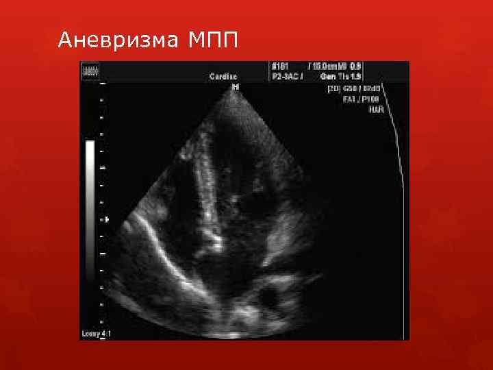 Аневризма межпредсердной перегородки. Аневризматическое выпячивание МПП. Аневризма МПП сердца у ребенка. Аневризматическая трансформация МПП. Аневризма МПП сердца 7мм.