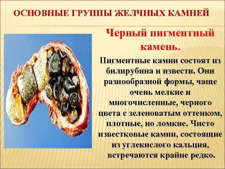 ОСНОВНЫЕ ГРУППЫ ЖЕЛЧНЫХ КАМНЕЙ Черный пигментный камень. Пигментные камни состоят из билирубина и извести.