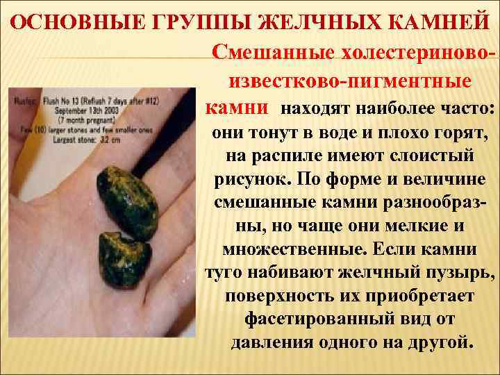 ОСНОВНЫЕ ГРУППЫ ЖЕЛЧНЫХ КАМНЕЙ Смешанные холестериновоизвестково-пигментные камни находят наиболее часто: они тонут в воде