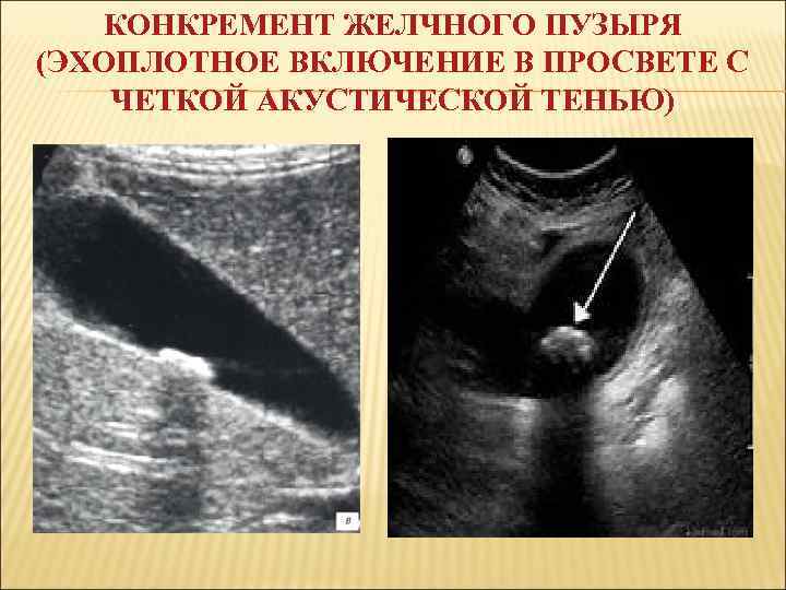 КОНКРЕМЕНТ ЖЕЛЧНОГО ПУЗЫРЯ (ЭХОПЛОТНОЕ ВКЛЮЧЕНИЕ В ПРОСВЕТЕ С ЧЕТКОЙ АКУСТИЧЕСКОЙ ТЕНЬЮ) 