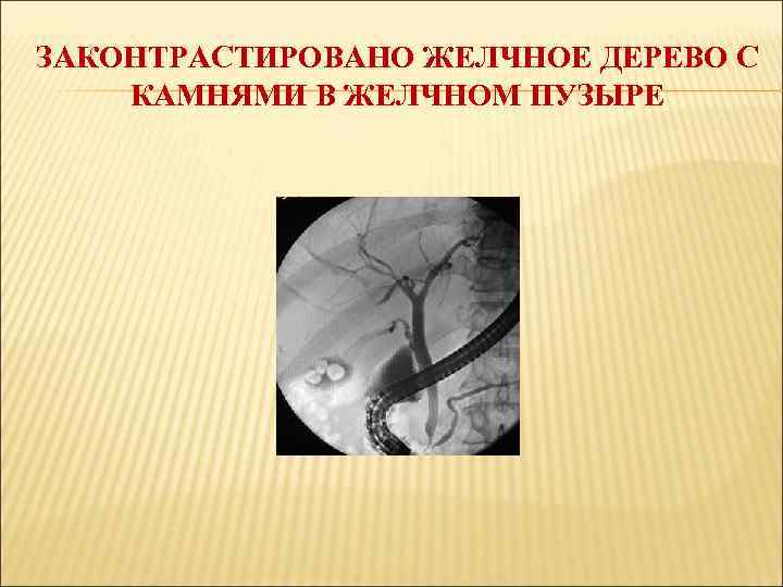 ЗАКОНТРАСТИРОВАНО ЖЕЛЧНОЕ ДЕРЕВО С КАМНЯМИ В ЖЕЛЧНОМ ПУЗЫРЕ 