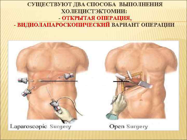 СУЩЕСТВУЮТ ДВА СПОСОБА ВЫПОЛНЕНИЯ ХОЛЕЦИСТЭКТОМИИ: - ОТКРЫТАЯ ОПЕРАЦИЯ, - ВИДИОЛАПАРОСКОПИЧЕСКИЙ ВАРИАНТ ОПЕРАЦИИ 