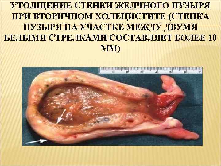 УТОЛЩЕНИЕ СТЕНКИ ЖЕЛЧНОГО ПУЗЫРЯ ПРИ ВТОРИЧНОМ ХОЛЕЦИСТИТЕ (СТЕНКА ПУЗЫРЯ НА УЧАСТКЕ МЕЖДУ ДВУМЯ БЕЛЫМИ