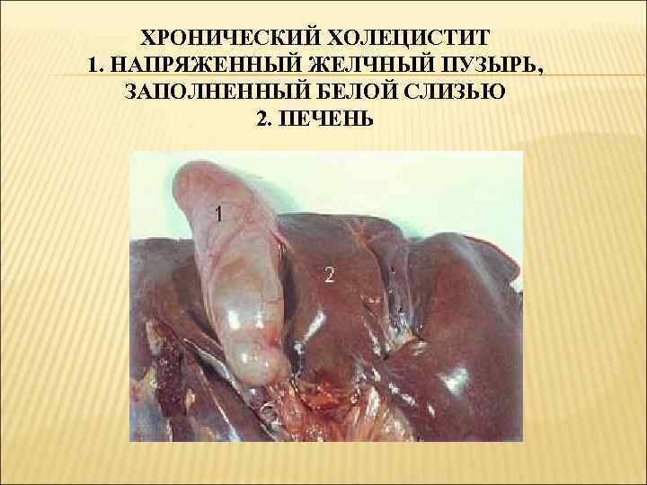 ХРОНИЧЕСКИЙ ХОЛЕЦИСТИТ 1. НАПРЯЖЕННЫЙ ЖЕЛЧНЫЙ ПУЗЫРЬ, ЗАПОЛНЕННЫЙ БЕЛОЙ СЛИЗЬЮ 2. ПЕЧЕНЬ 
