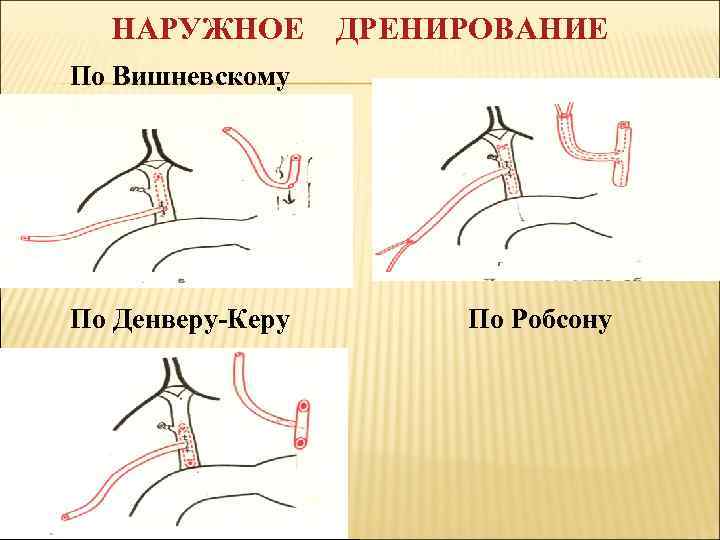 НАРУЖНОЕ ДРЕНИРОВАНИЕ По Вишневскому По Стерлингу По Денверу-Керу По Робсону 
