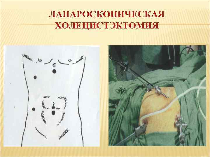 ЛАПАРОСКОПИЧЕСКАЯ ХОЛЕЦИСТЭКТОМИЯ 