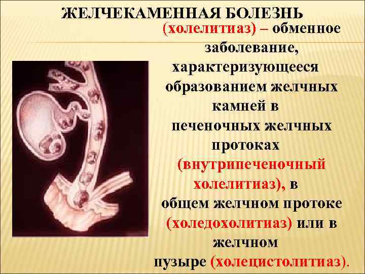 ЖЕЛЧЕКАМЕННАЯ БОЛЕЗНЬ (холелитиаз) – обменное заболевание, характеризующееся образованием желчных камней в печеночных желчных протоках