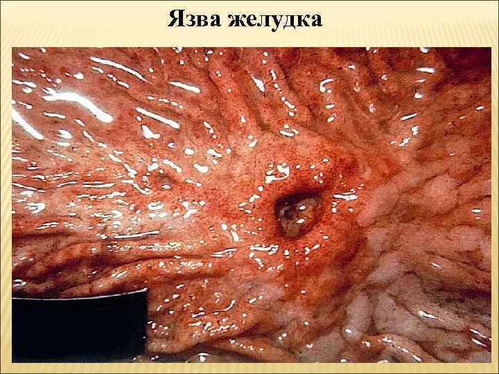 Язва желудка 