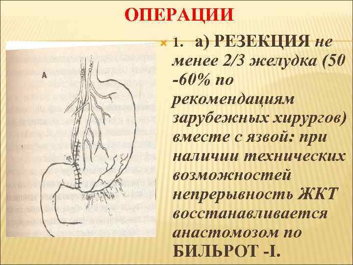 ОПЕРАЦИИ а) РЕЗЕКЦИЯ не менее 2/3 желудка (50 -60% по рекомендациям зарубежных хирургов) вместе