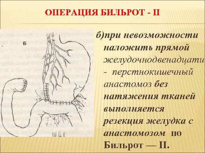 ОПЕРАЦИЯ БИЛЬРОТ - II б)при невозможности наложить прямой желудочнодвенадцати - перстнокишечный анастомоз без натяжения
