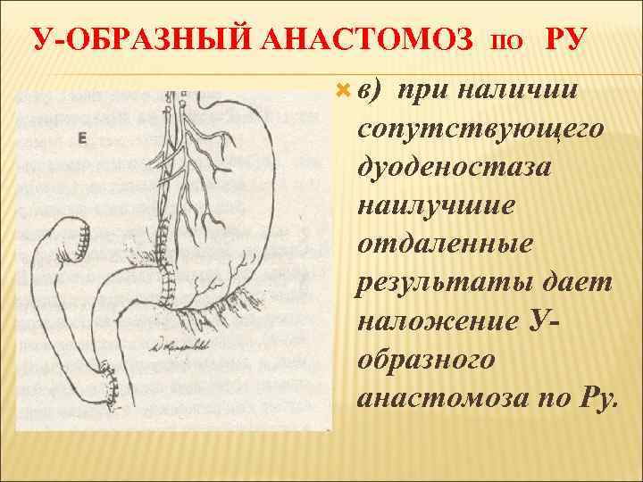 У-ОБРАЗНЫЙ АНАСТОМОЗ в) ПО РУ при наличии сопутствующего дуоденостаза наилучшие отдаленные результаты дает наложение