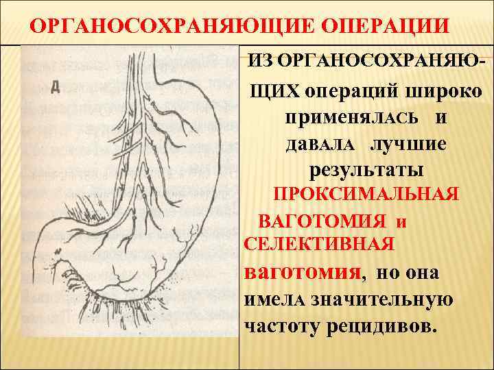 ОРГАНОСОХРАНЯЮЩИЕ ОПЕРАЦИИ ИЗ ОРГАНОСОХРАНЯЮЩИХ операций широко применя. ЛАСЬ и да. ВАЛА лучшие результаты ПРОКСИМАЛЬНАЯ