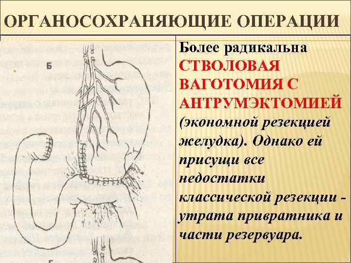 ОРГАНОСОХРАНЯЮЩИЕ ОПЕРАЦИИ Более радикальна СТВОЛОВАЯ ВАГОТОМИЯ С АНТРУМЭКТОМИЕЙ (экономной резекцией желудка). Однако ей присущи
