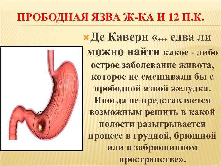 ПРОБОДНАЯ ЯЗВА Ж-КА И 12 П. К. Де Каверн «. . . едва ли