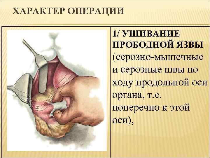 ХАРАКТЕР ОПЕРАЦИИ 1/ УШИВАНИЕ ПРОБОДНОЙ ЯЗВЫ (серозно-мышечные и серозные швы по ходу продольной оси