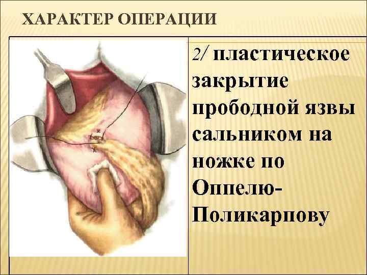 ХАРАКТЕР ОПЕРАЦИИ 2/ пластическое закрытие прободной язвы сальником на ножке по Оппелю. Поликарпову 