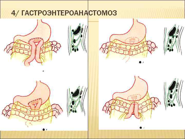 4/ ГАСТРОЭНТЕРОАНАСТОМОЗ 
