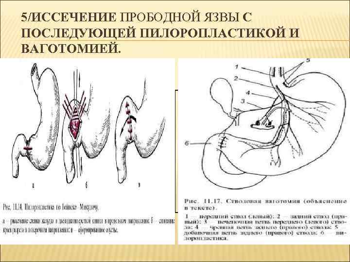 5/ИССЕЧЕНИЕ ПРОБОДНОЙ ЯЗВЫ С ПОСЛЕДУЮЩЕЙ ПИЛОРОПЛАСТИКОЙ И ВАГОТОМИЕЙ. 