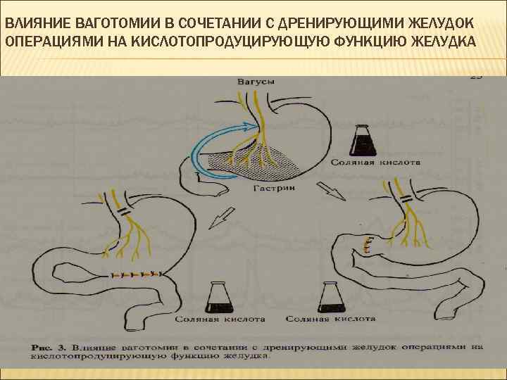 ВЛИЯНИЕ ВАГОТОМИИ В СОЧЕТАНИИ С ДРЕНИРУЮЩИМИ ЖЕЛУДОК ОПЕРАЦИЯМИ НА КИСЛОТОПРОДУЦИРУЮЩУЮ ФУНКЦИЮ ЖЕЛУДКА 