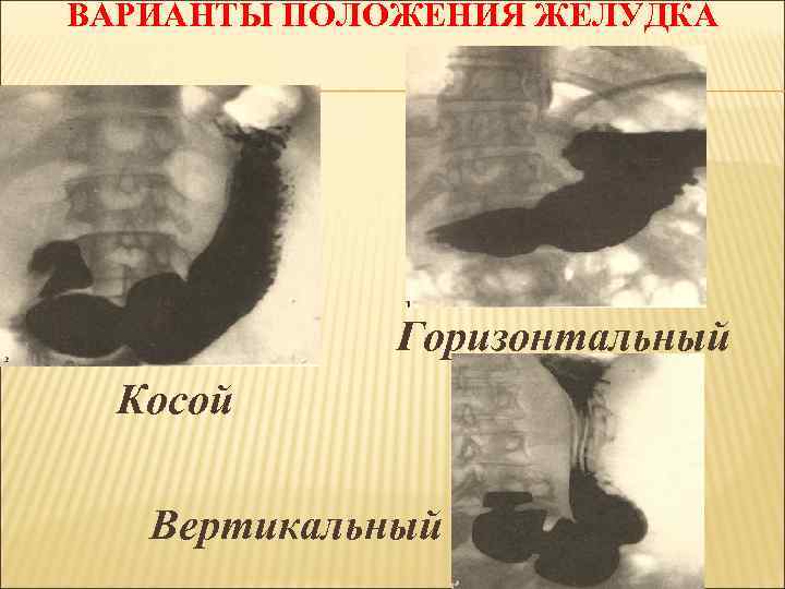 ВАРИАНТЫ ПОЛОЖЕНИЯ ЖЕЛУДКА Горизонтальный Косой Вертикальный 