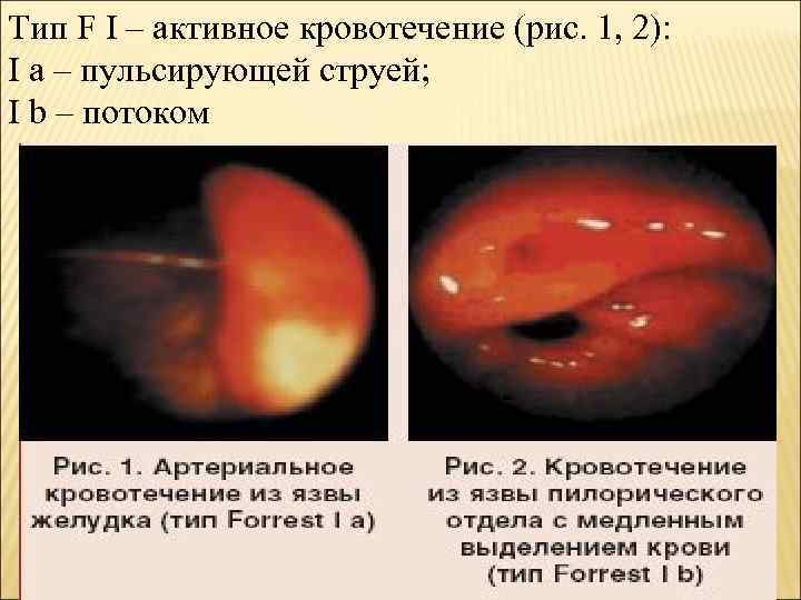 Тип F I – активное кровотечение (рис. 1, 2): I a – пульсирующей струей;